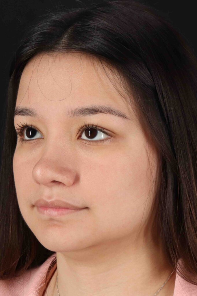 After - left_oblique