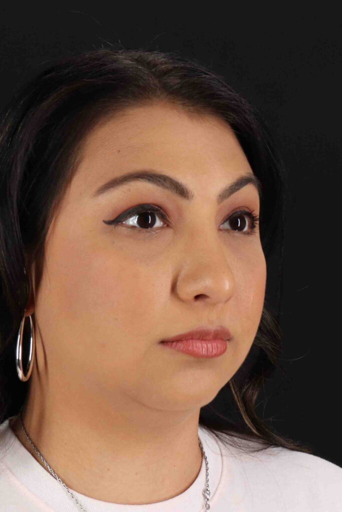 After - right_oblique