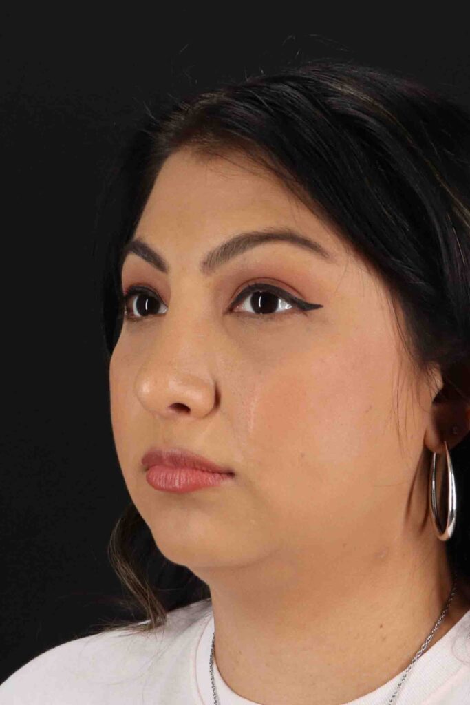 After - left_oblique