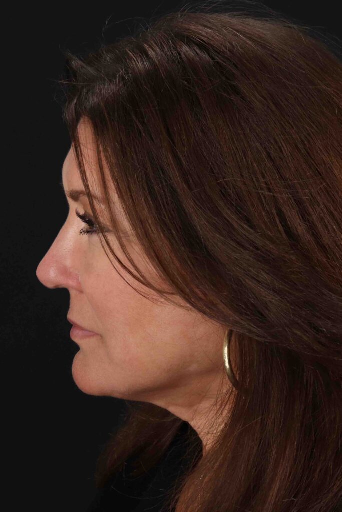 After - left_lateral