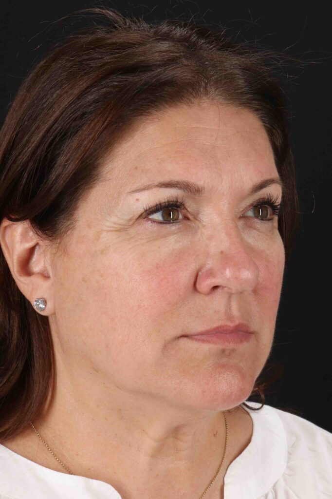 Before - right_oblique