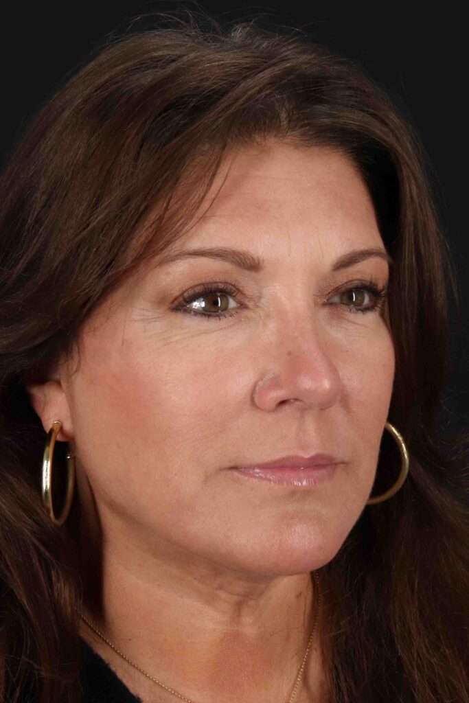 After - right_oblique