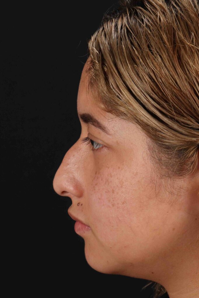 Before - left_lateral