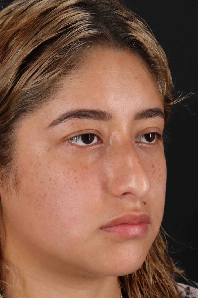 Before - right_oblique