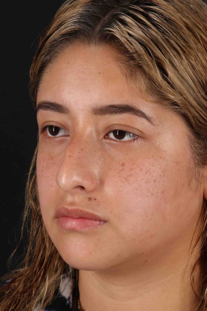 Before - left_oblique