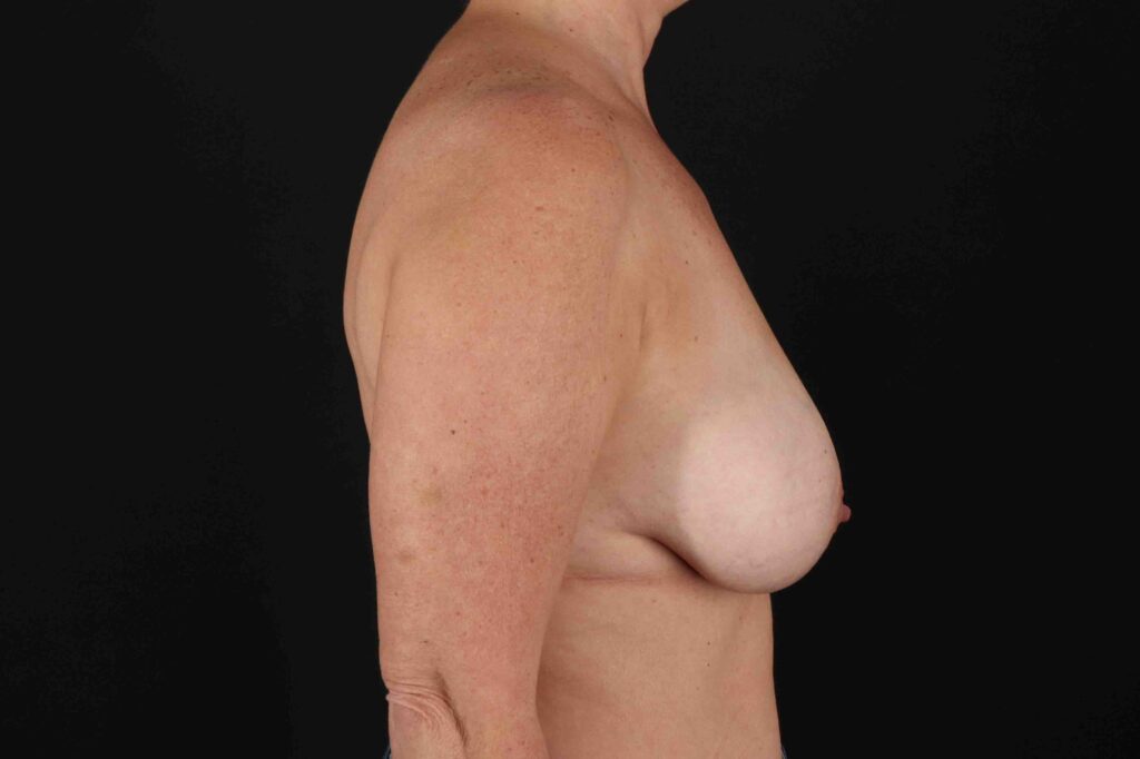 Before - right_lateral