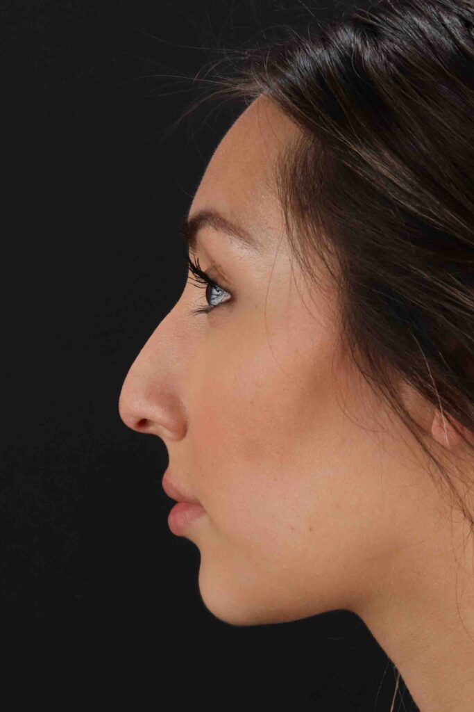 Before - left_lateral