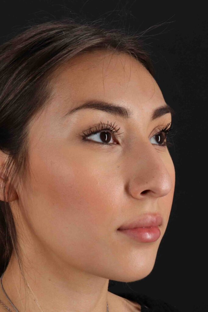 Before - right_oblique