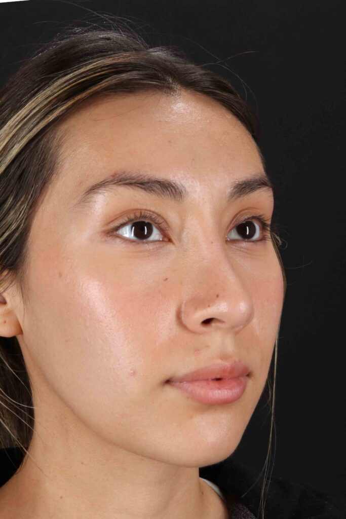 After - right_oblique