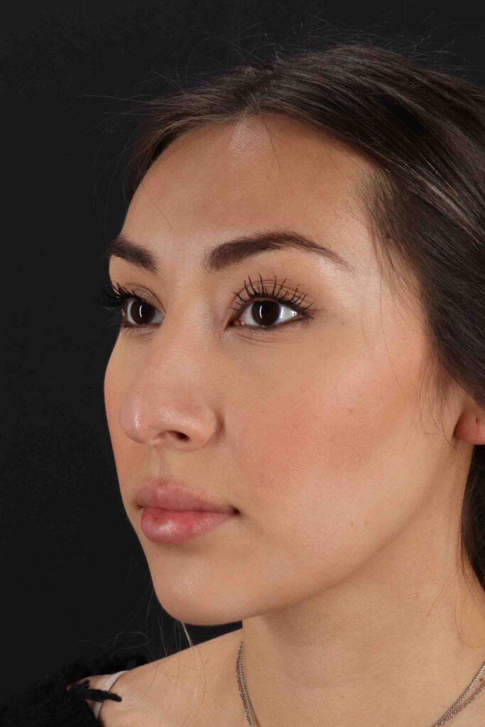 Before - left_oblique