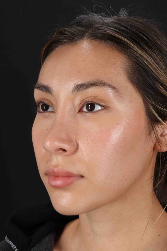 After - left_oblique