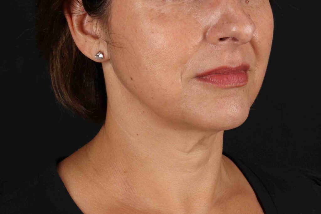 Before - right_oblique