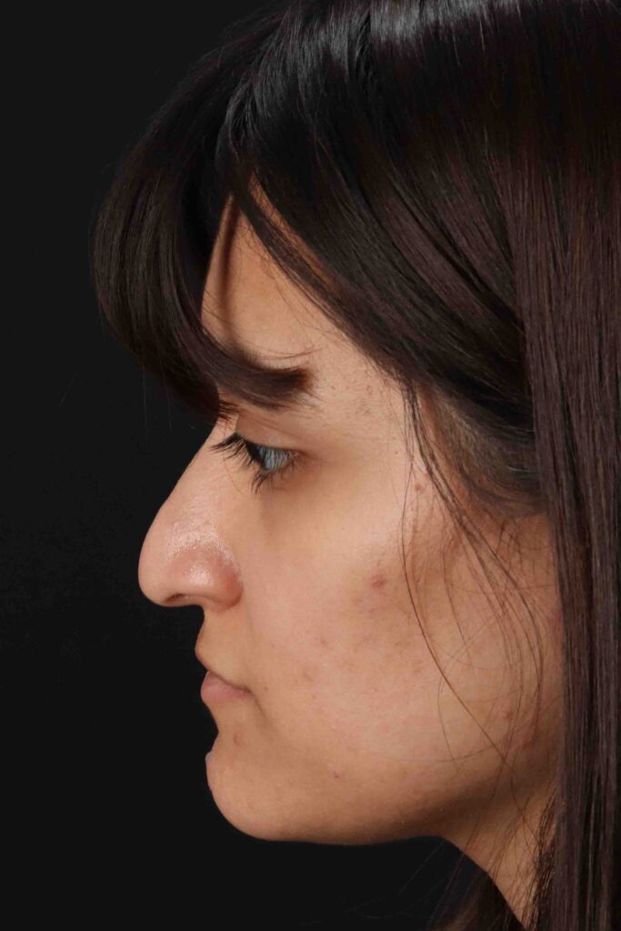 Before - left_lateral