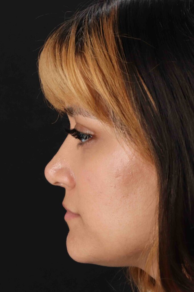 After - left_lateral