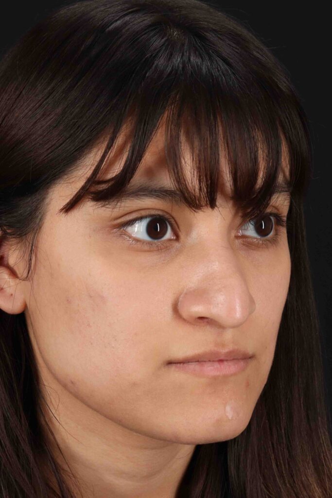 Before - right_oblique