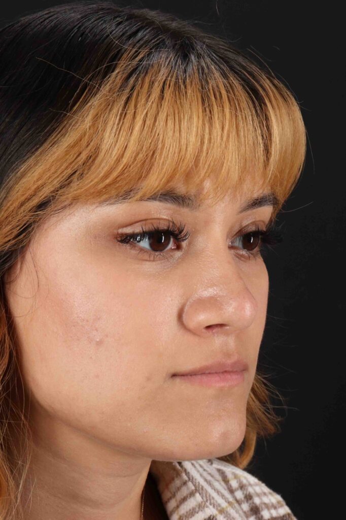 After - right_oblique