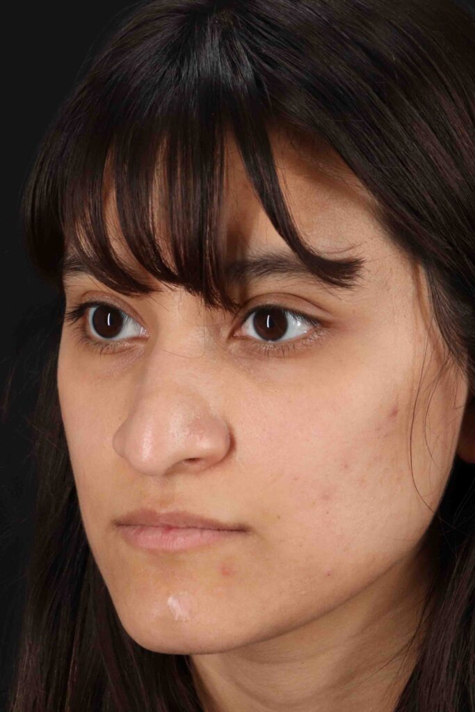 Before - left_oblique