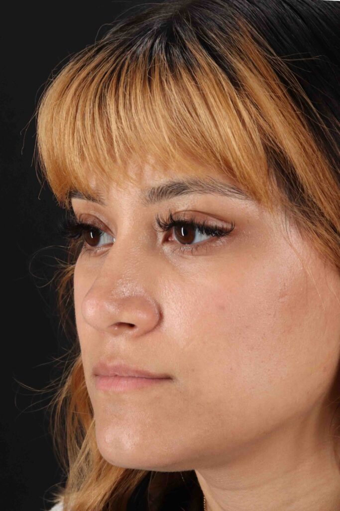 After - left_oblique