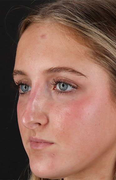 After - left_oblique