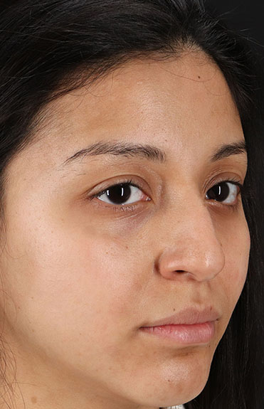 Before - right_oblique