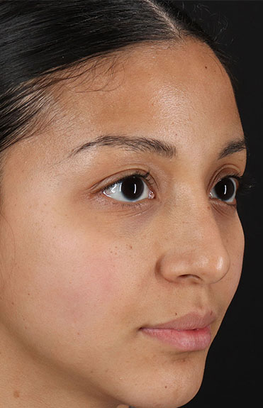 After - right_oblique