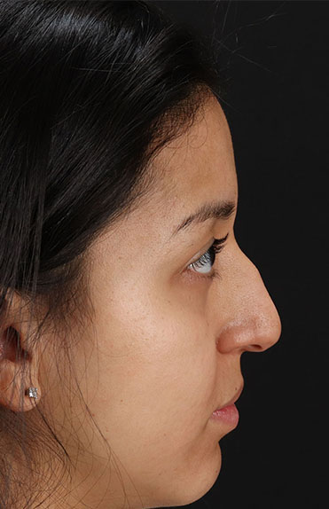 Before - right_lateral