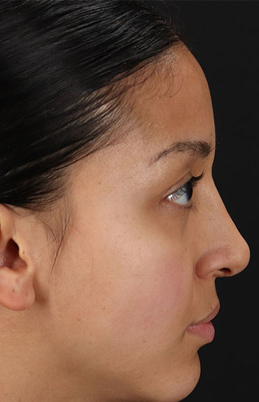 After - right_lateral