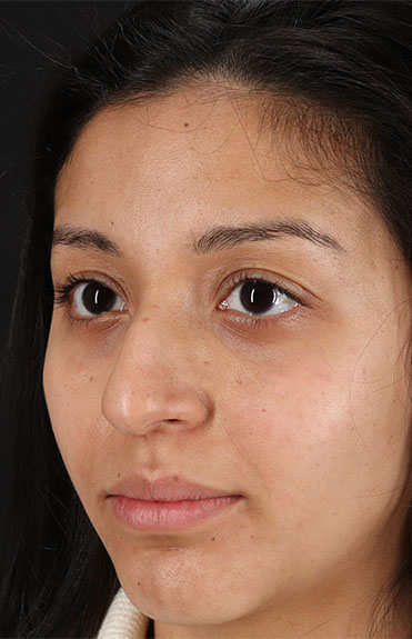 Before - left_oblique