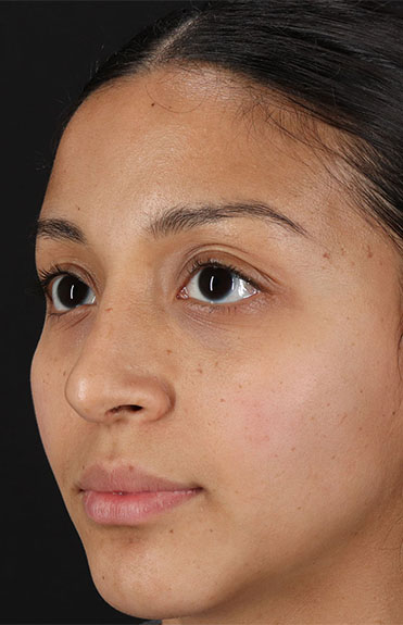 After - left_oblique