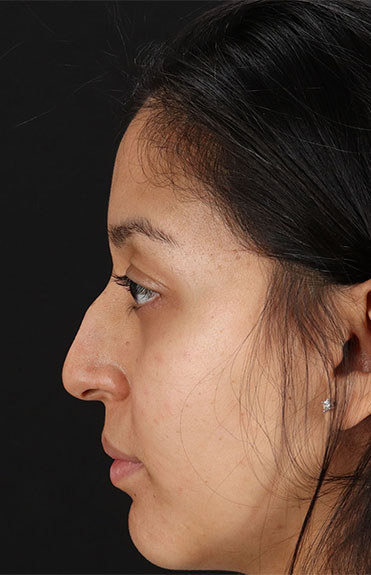 Before - left_lateral