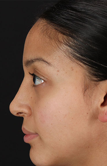 After - left_lateral