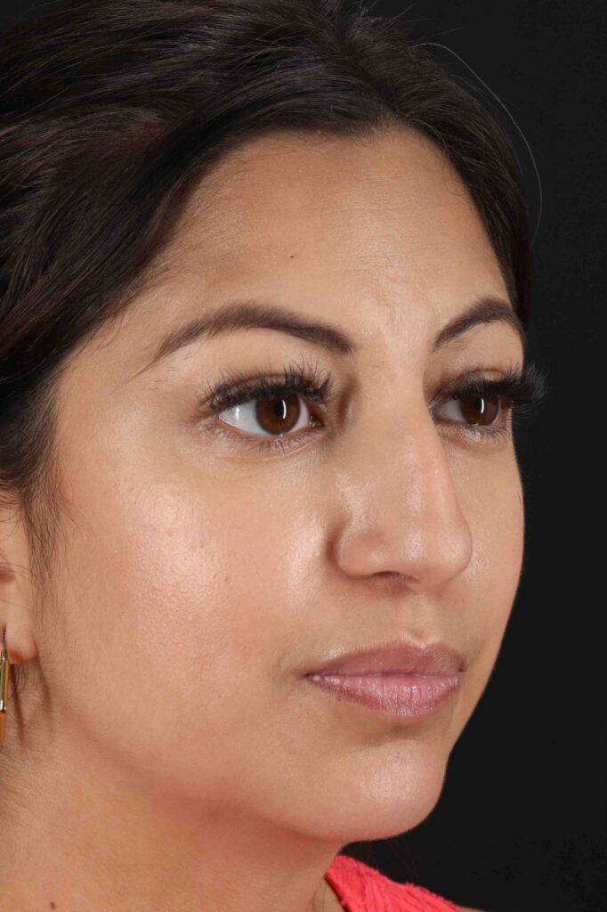 Before - right_oblique