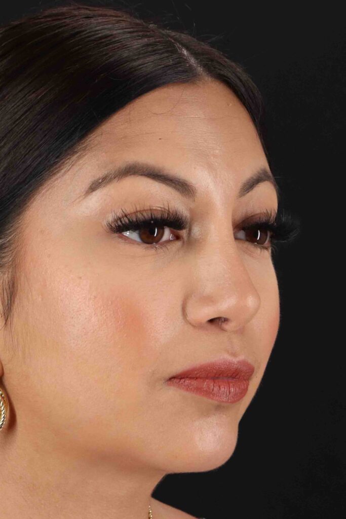 After - right_oblique