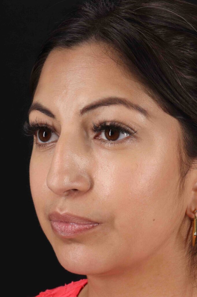 Before - left_oblique