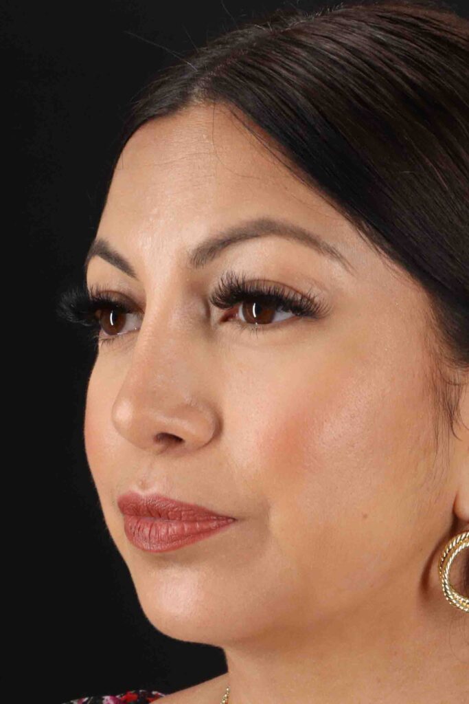 After - left_oblique