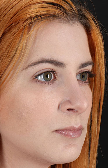 After - right_oblique