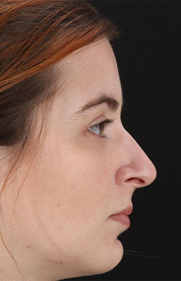 Before - right_lateral