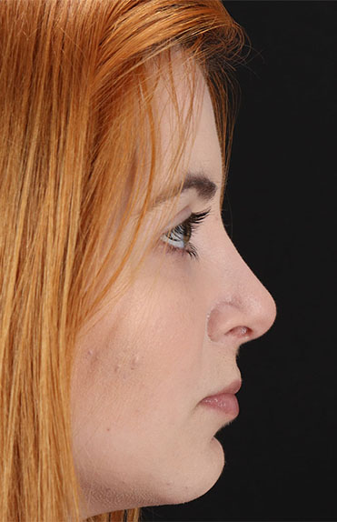 After - right_lateral