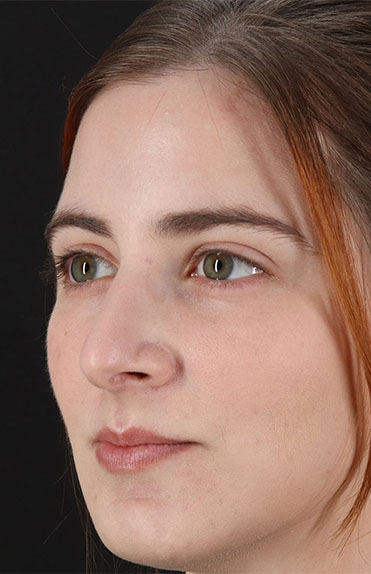 Before - left_oblique