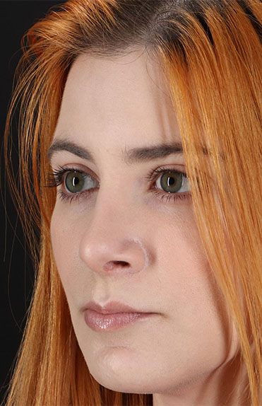 After - left_oblique