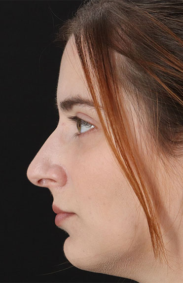 Before - left_lateral