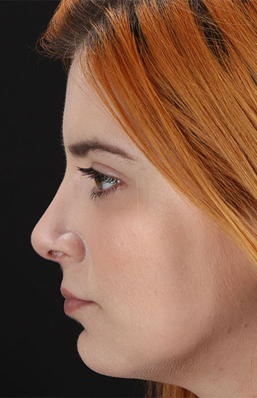 After - left_lateral