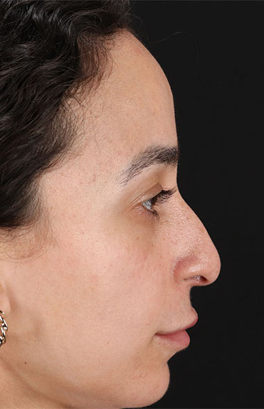 Before - right_lateral