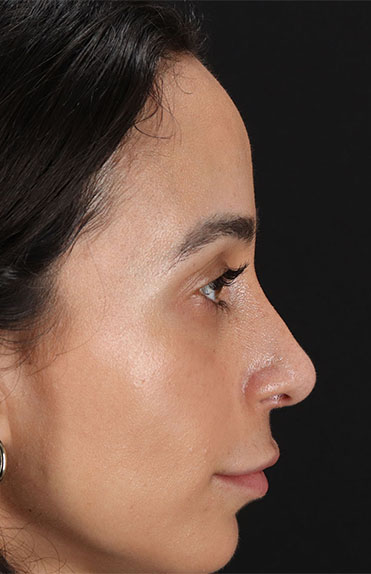 After - right_lateral