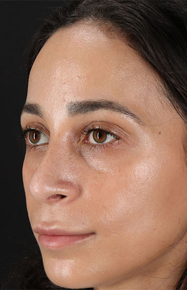 After - left_oblique