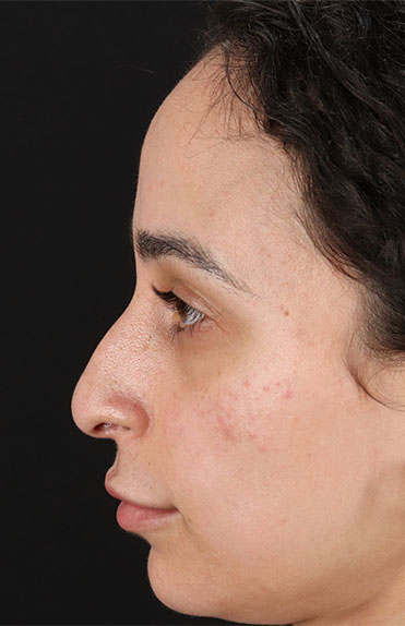 Before - left_lateral