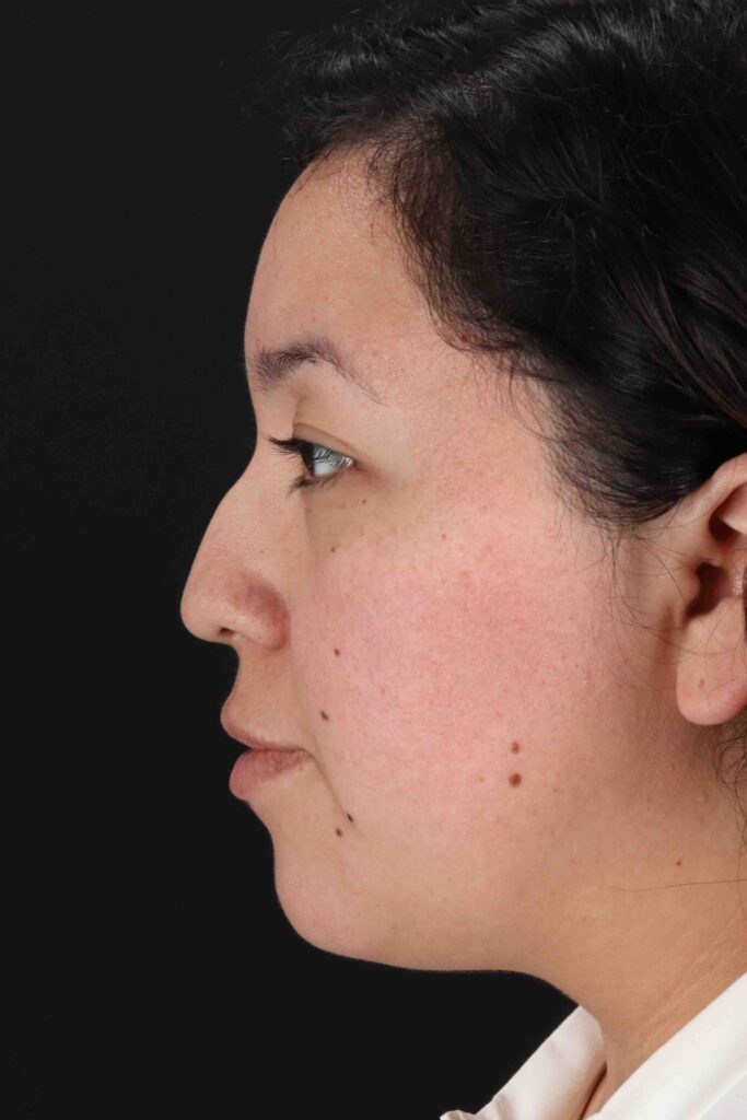 Before - left_lateral