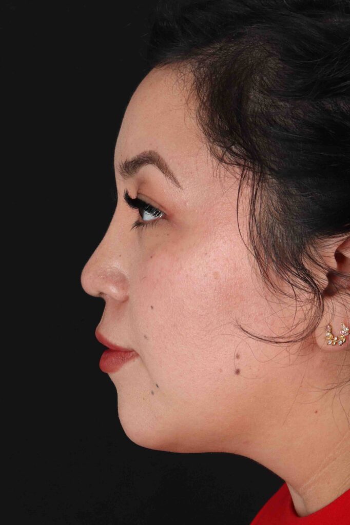 After - left_lateral