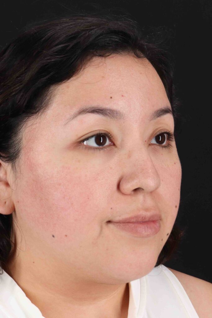 Before - right_oblique