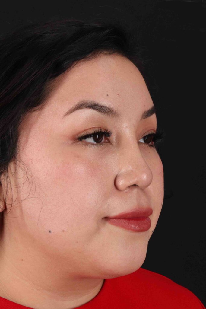 After - right_oblique